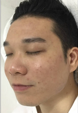Customer skin after using the product